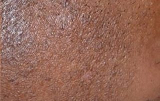 Best Laser Hair Removal In Charlotte Nc Smartchoicelist Best Laser Hair Removal In Charlotte Nc Smartchoicelist